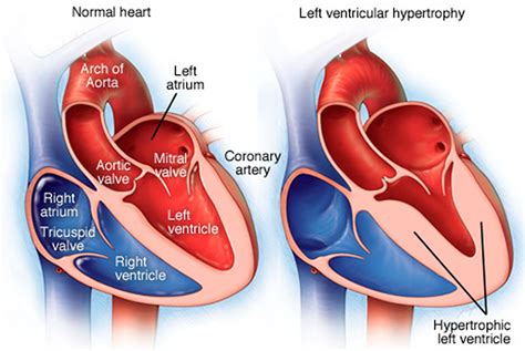 lv cardiology|Left Ventricular Structure and Risk of Cardiovascular Events: A .